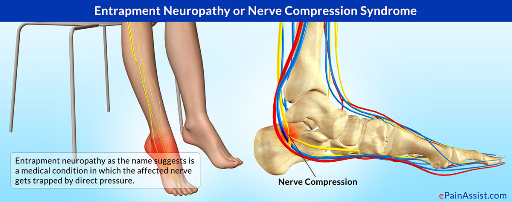 surgical-decompression-for-compression-neuropathy-offers-many