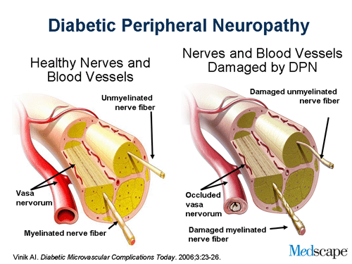 The Four Types Of Diabetic Neuropathy Dr Michael A Castillo MD