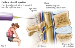 Epidural Steroid Injection Dr Michael A Castillo Md