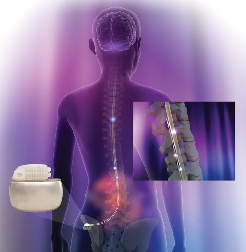 Spinal Cord Stimulation Reduces Emotional Aspect Of Chronic Pain AZ