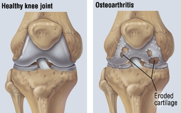 regenerative therapies for osteoarthritis