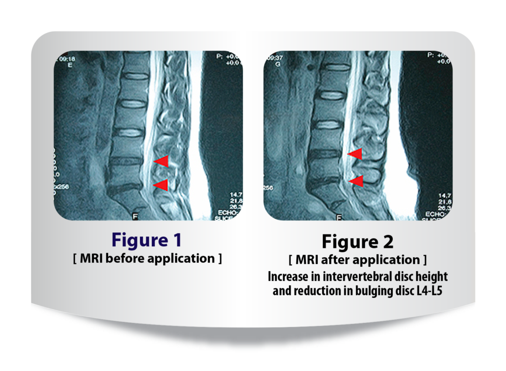 MRI view of before and after lumbar brace