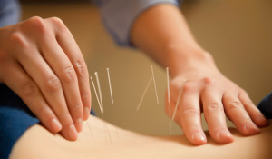 5 natural neuropathy treatments -accupuncture