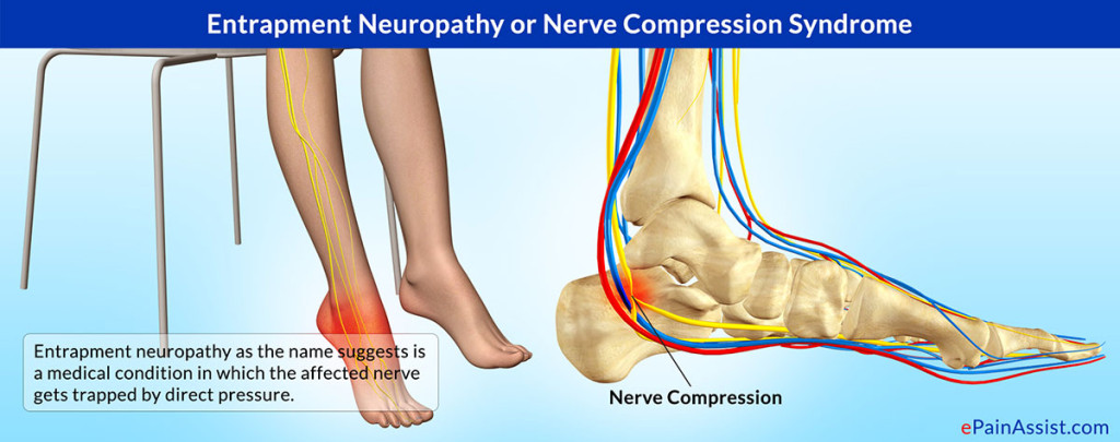 Surgical Decompression for Compression Neuropathy