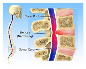 nonsurgical treatments for spinal stenosis