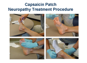 Capsaicin Patch for neuropathy treatment