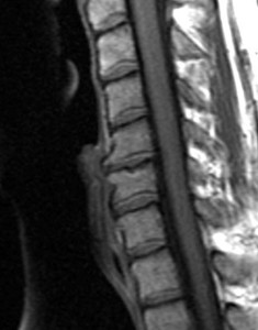 Degenerative Disc Disorder MRI