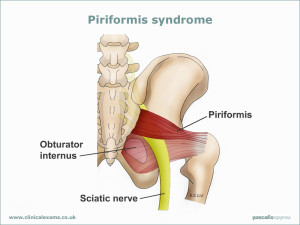 Piriformis syndrome