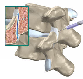 Thoracic Facet Joint Injection