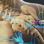 Caudal Injection