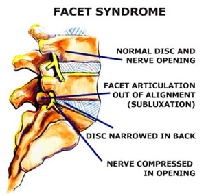 Facet Joint Syndrome - pinched nerve