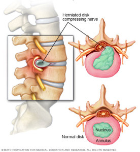 Herniated Disc