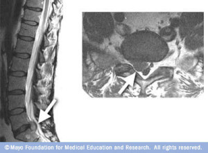 MRI image of herniated disc