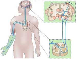 phantom limb pain