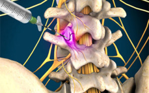 Radio-frequency Injection for back pain