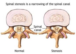 Spinal Stenosis illustration