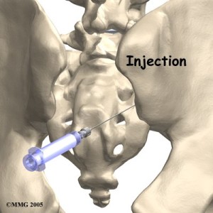 image of sacroiliac joint injection