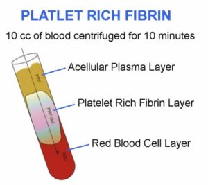 platelet rich fibrin. illustration of tube with platelet rich fibrin