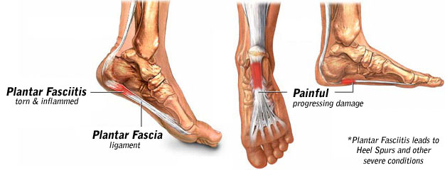 Why is Plantar Fasciitis so Hard to Heal?