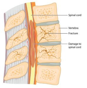 spinal osteoarthritis fracture