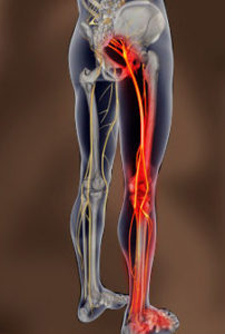 leg pain, possibly hamstring tendinopathy. vector image showing pain radiating down leg from hip to toes. 