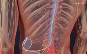 intrathecal pain pump, image of pump implanted in torso with leads along spine