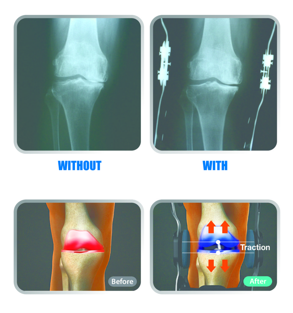 knee brace before and after