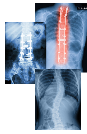 xrays of failed back surgery and scoliosis