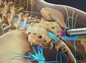 Dr. Castillo Procedure videos. Image of pain therapy injection